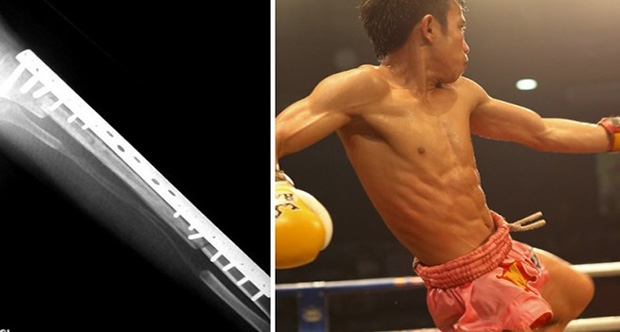 Muay Thai dövüşçüsünün titanyum kemiği hilesi
