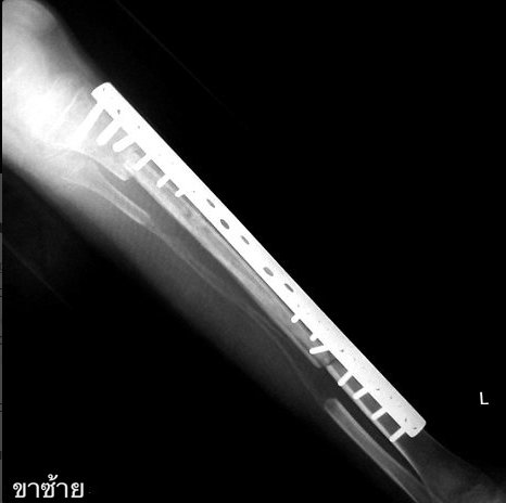 Muay Thai dövüşçüsünün titanyum kemiği hilesi