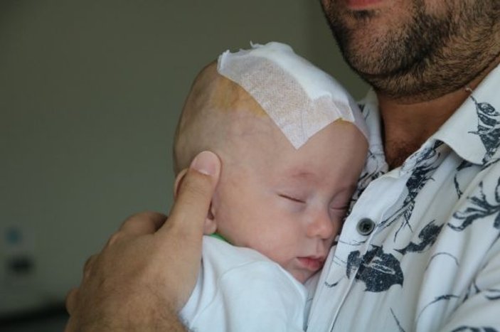 Kayseri'de prematüre doğan bebeğe beyin ameliyatı
