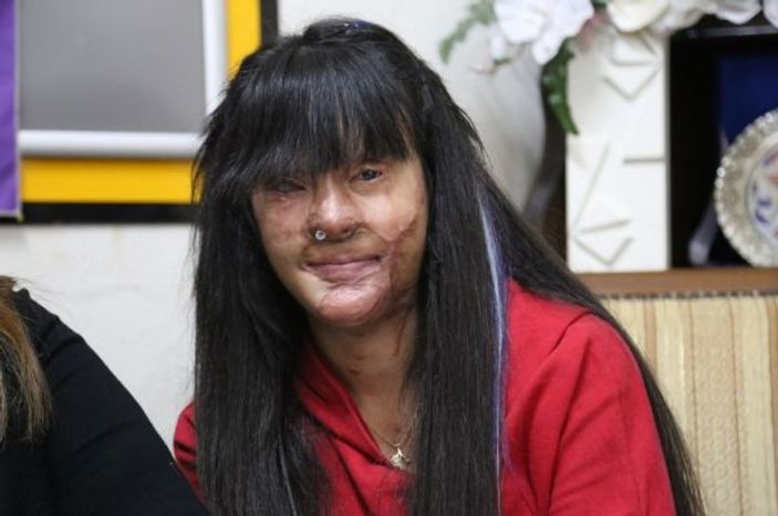 Yüzü asitle yakılan Berfin: Çektiğimiz bir iki yıla sığacak acı değil -1