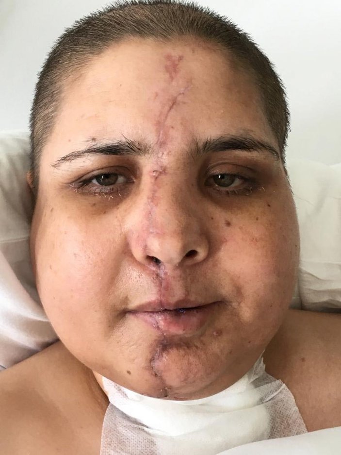 Eskişehir'de kazada ikiye ayrılan yüzü ameliyatla birleştirildi
