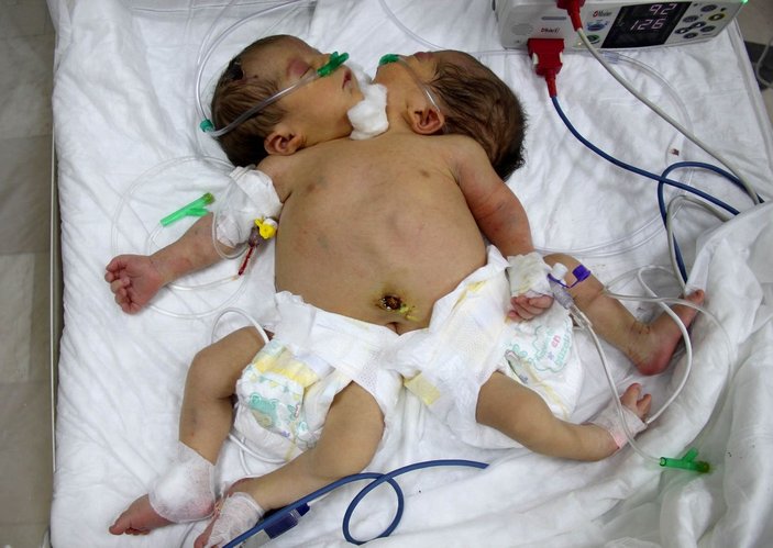 Tek kalple hayata tutunan ‘siyam ikizleri’ tedavi altına alındı -1