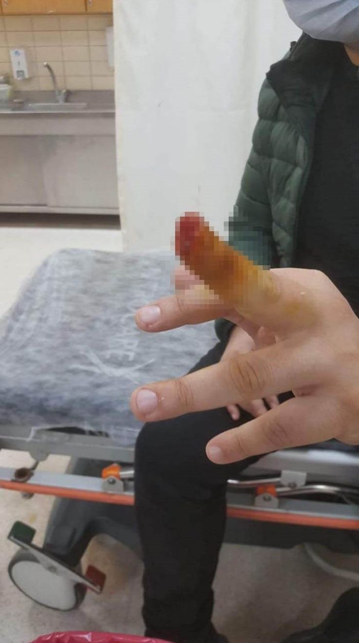 d parmağı ısırıp kopardı