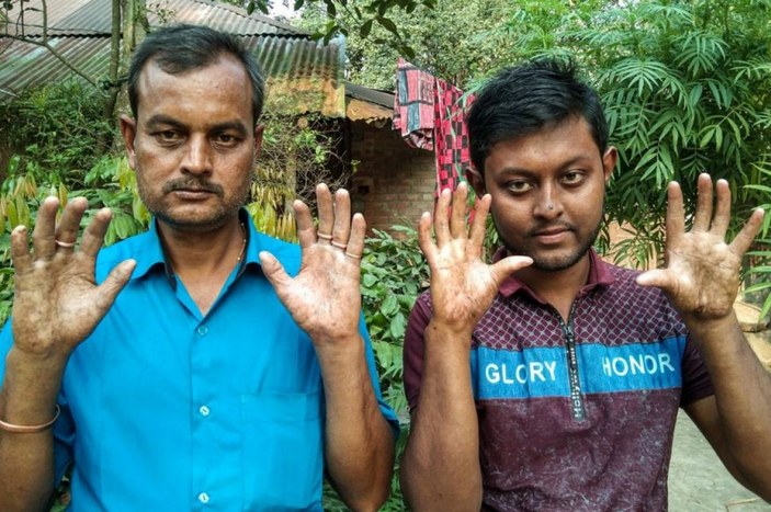 Bangladeş’te parmak izi olmayan aile görenleri şaşkına çevirdi -2