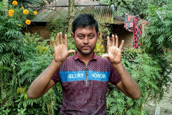 Bangladeş’te parmak izi olmayan aile görenleri şaşkına çevirdi -1