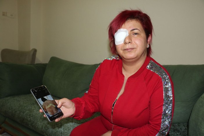 Alerji olan kadının derisi döküldü, sağ gözü görme kaybı yaşadı -5