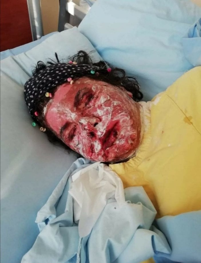 Alerji olan kadının derisi döküldü, sağ gözü görme kaybı yaşadı -8