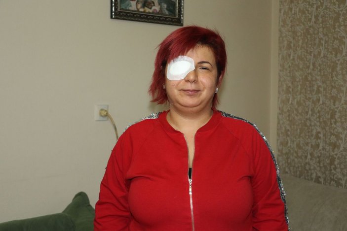 Alerji olan kadının derisi döküldü, sağ gözü görme kaybı yaşadı -3