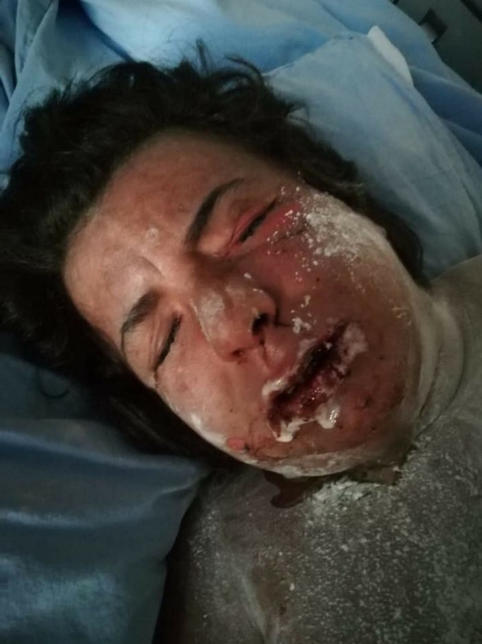 Alerji olan kadının derisi döküldü, sağ gözü görme kaybı yaşadı -7