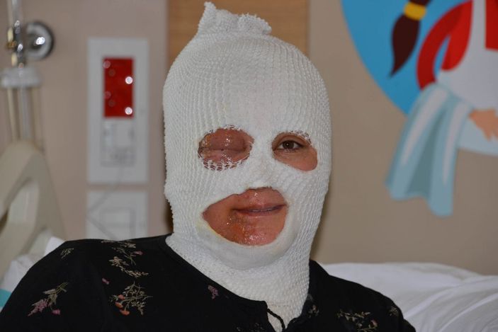 Demlediği çay üstüne dökülen kadın ağır yaralandı -2