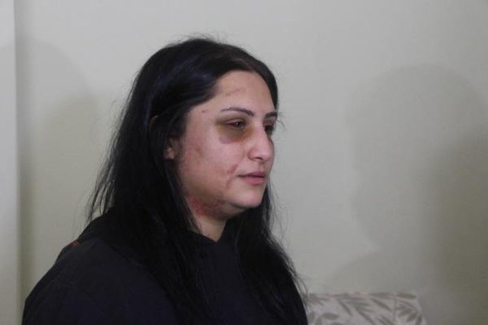 Samsun'da eski eşinin dövdüğü kadın: Şiddet sessiz kalındıkça çoğalıyor -2