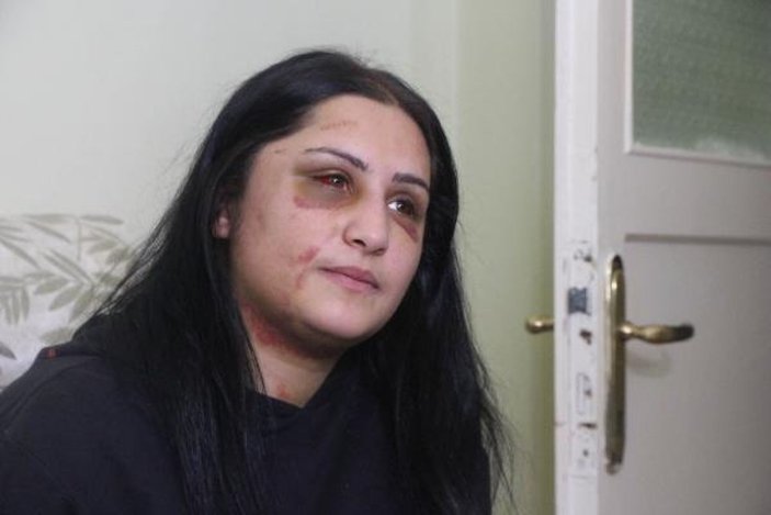 Samsun'da eski eşinin dövdüğü kadın: Şiddet sessiz kalındıkça çoğalıyor -1