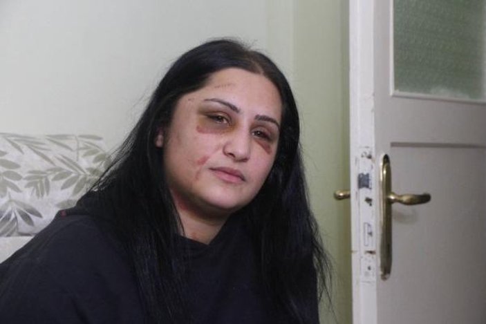 Samsun'da eski eşinin dövdüğü kadın: Şiddet sessiz kalındıkça çoğalıyor -3