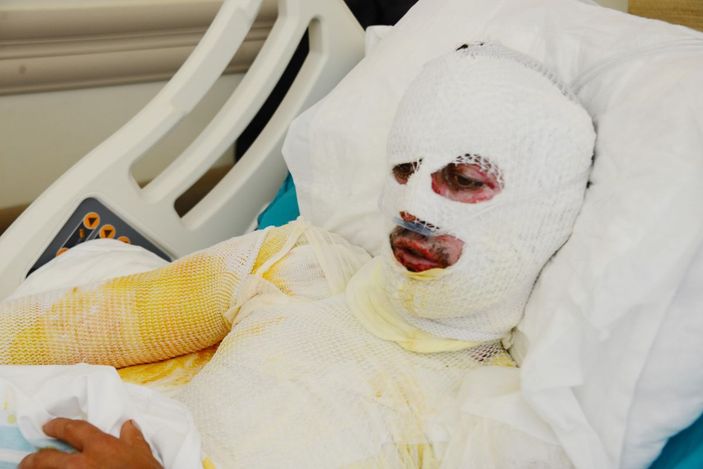 Üzerine yıldırım düşen çoban ağır yaralandı -2