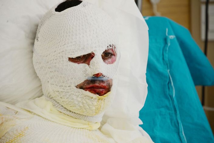 Üzerine yıldırım düşen çoban ağır yaralandı -1