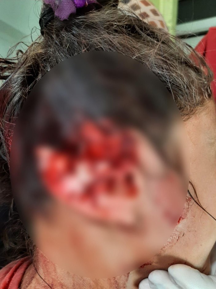 Alaz'ın köpek saldırısında kopan kulağına 300 dikiş -7