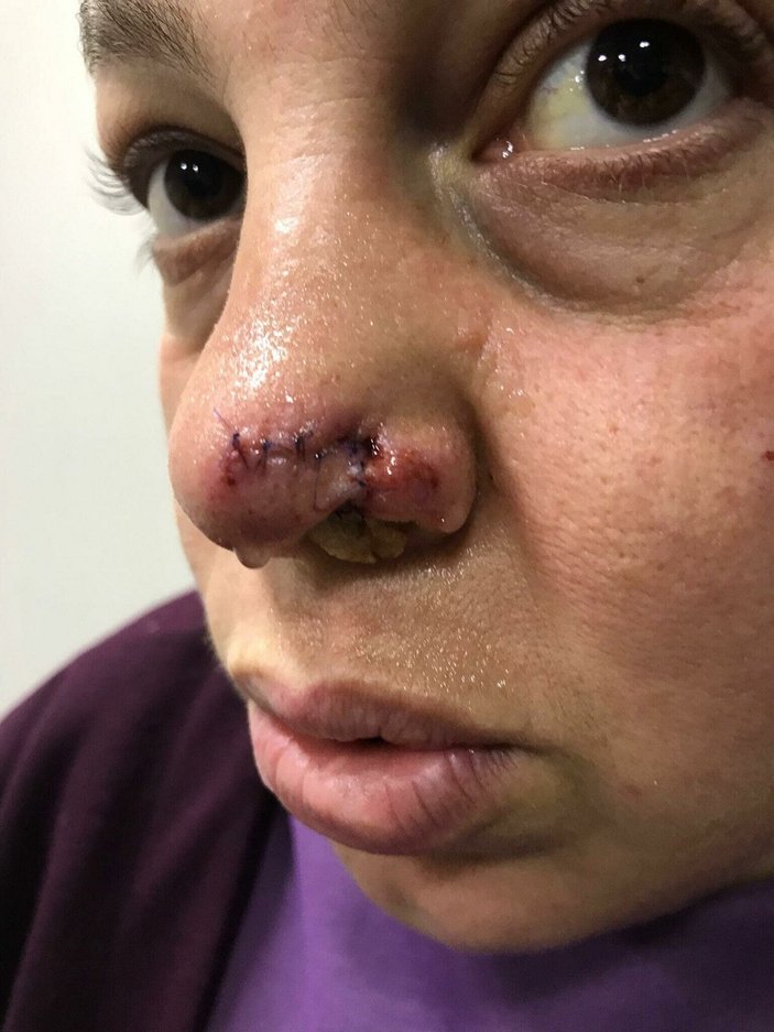 Spor yaparken pitbull saldırısında burnundan yaralandı -3