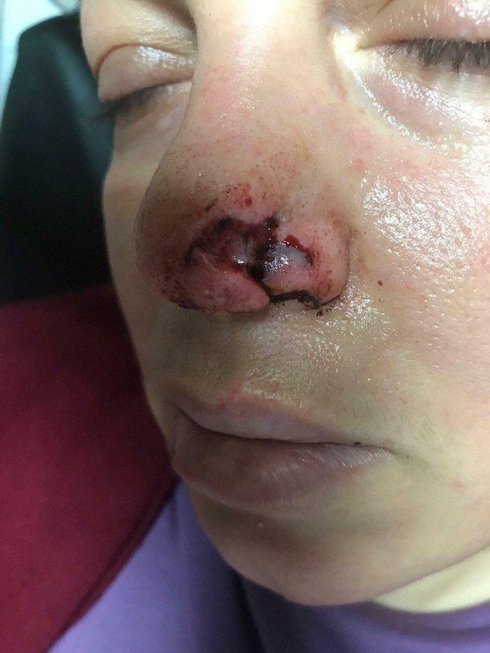 Spor yaparken pitbull saldırısında burnundan yaralandı -9