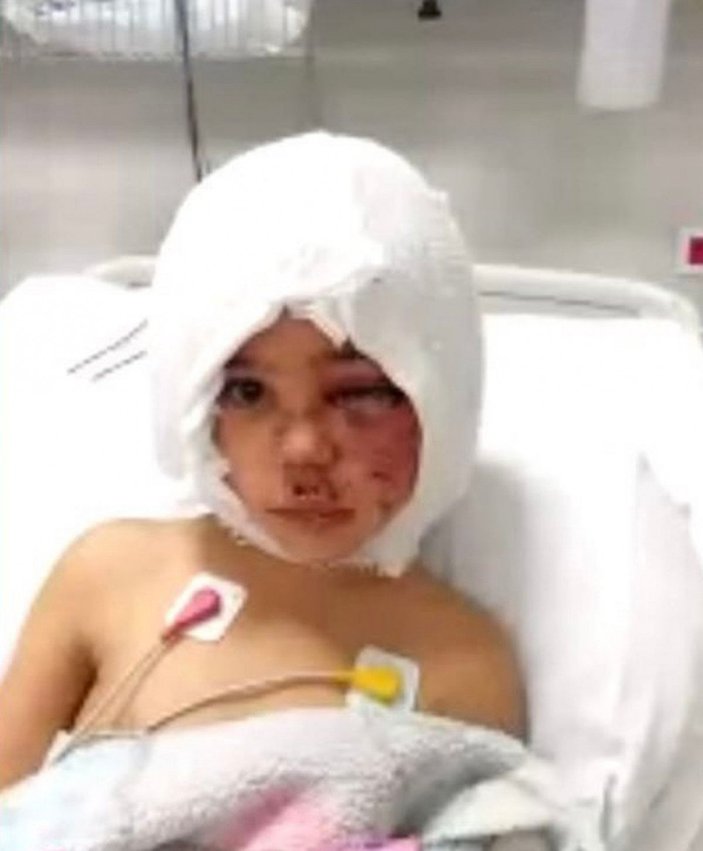 Pitbull saldırısında yaralanan Asiye'ye ikinci ameliyat 1 hafta sonra -3