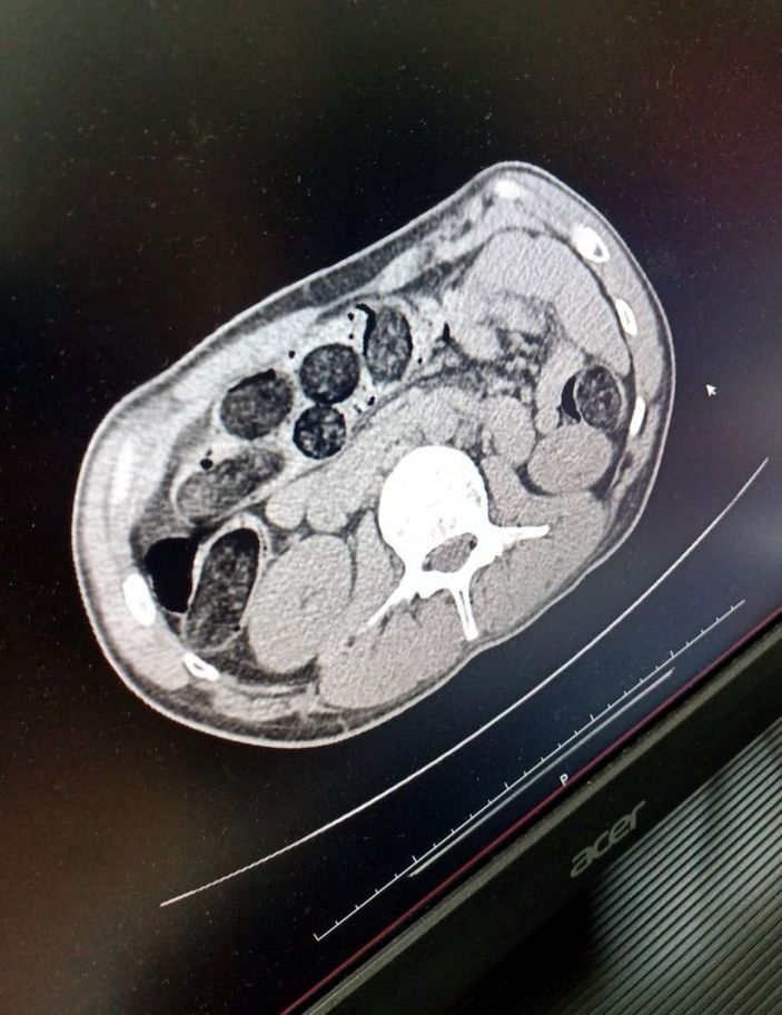 Midesinde 542 gram eroinle yakalandı -4