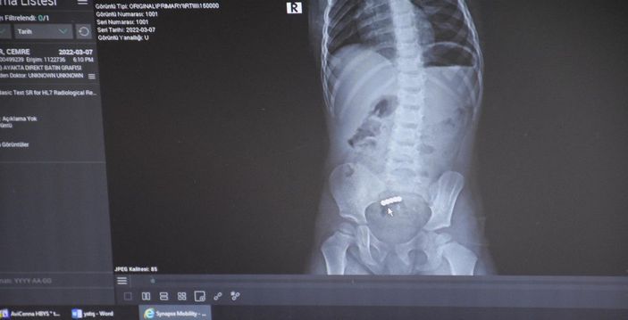 d Cemre'nin bağırsaklarından 5 tane mıknatıslı bilye çıktı -3
