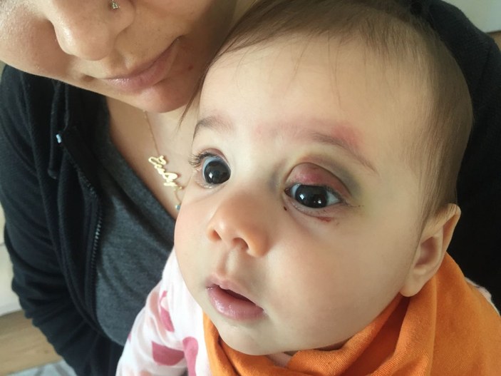 Göz kapağından ameliyat olan 7 aylık bebek bu hale geldi -4
