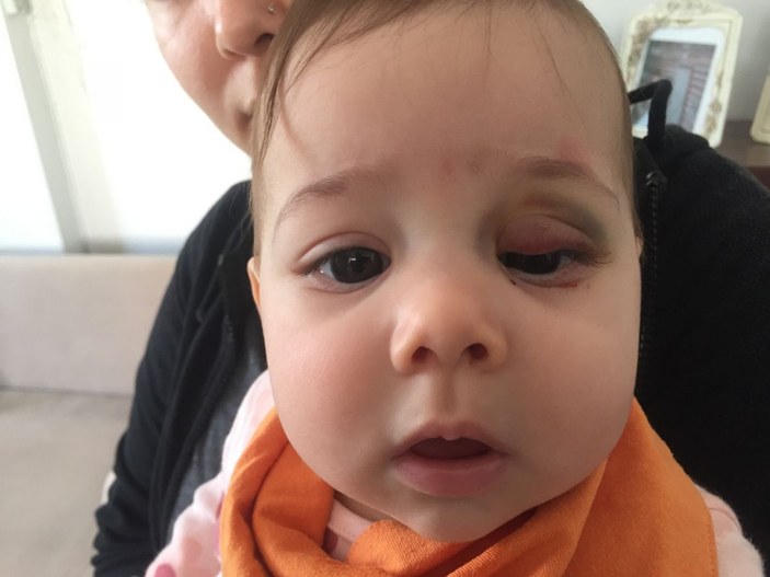 Göz kapağından ameliyat olan 7 aylık bebek bu hale geldi -3