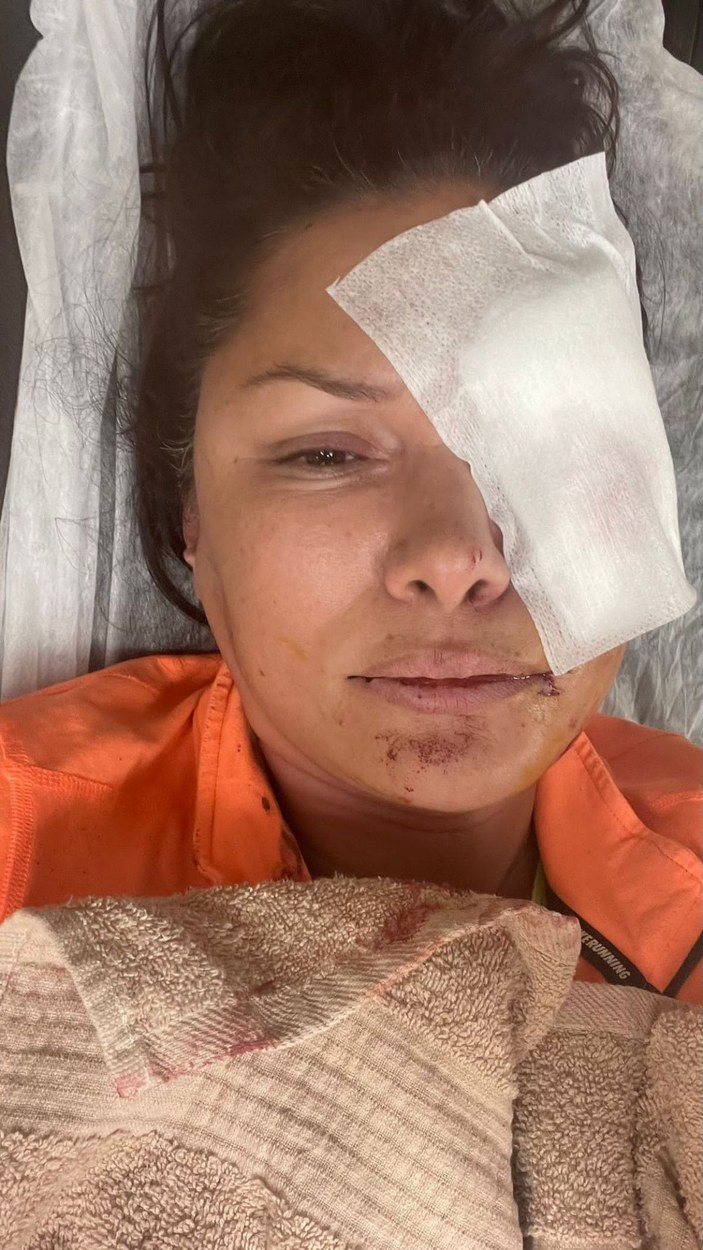 Şile'de köpek saldırısına uğrayan şarkıcı Tuğba Altıntop'un yüzüne dikiş atıldı -4