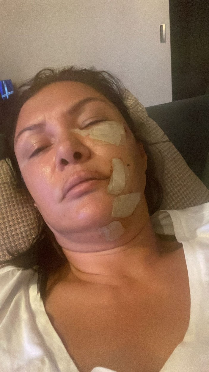 Şile'de köpek saldırısına uğrayan şarkıcı Tuğba Altıntop'un yüzüne dikiş atıldı -6