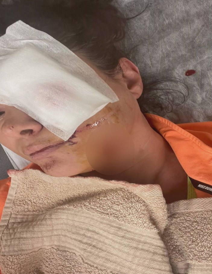 Şile'de köpek saldırısına uğrayan şarkıcı Tuğba Altıntop'un yüzüne dikiş atıldı -1