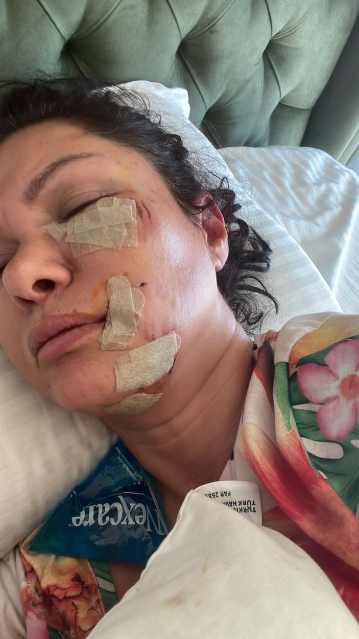 Şile'de köpek saldırısına uğrayan şarkıcı Tuğba Altıntop'un yüzüne dikiş atıldı -5