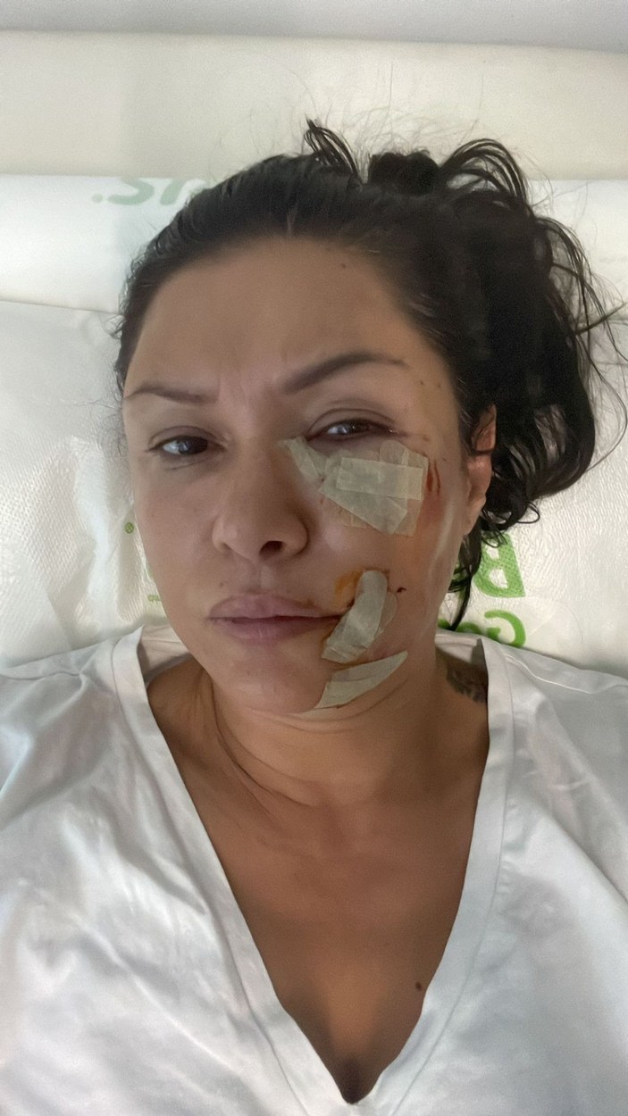 Şile'de köpek saldırısına uğrayan şarkıcı Tuğba Altıntop'un yüzüne dikiş atıldı -7