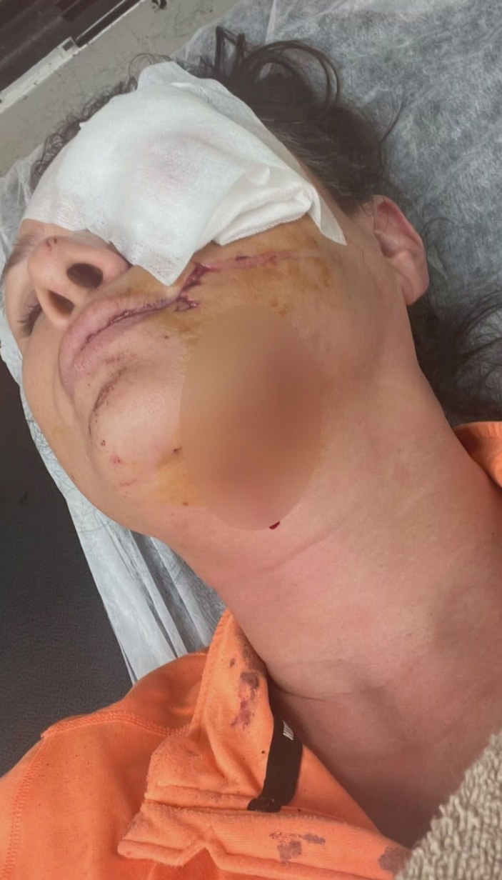 Şile'de köpek saldırısına uğrayan şarkıcı Tuğba Altıntop'un yüzüne dikiş atıldı -3