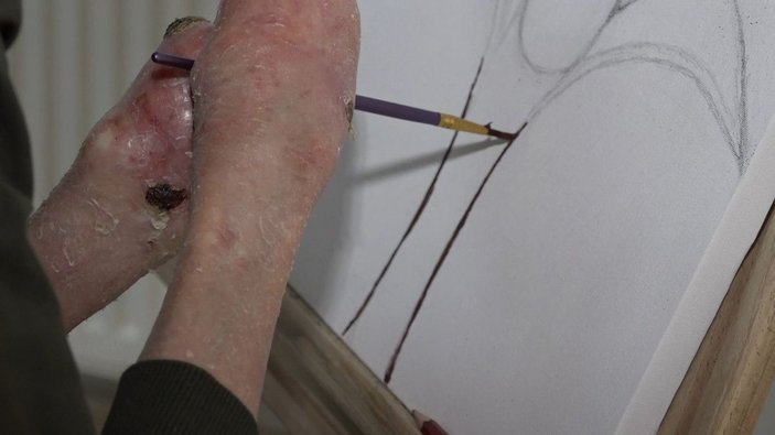 Kelebek hastalığından iki elini kaybeden Ömer, kollarıyla resim yapıyor -5