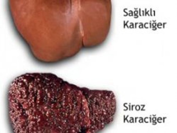 Siroz Nedir?