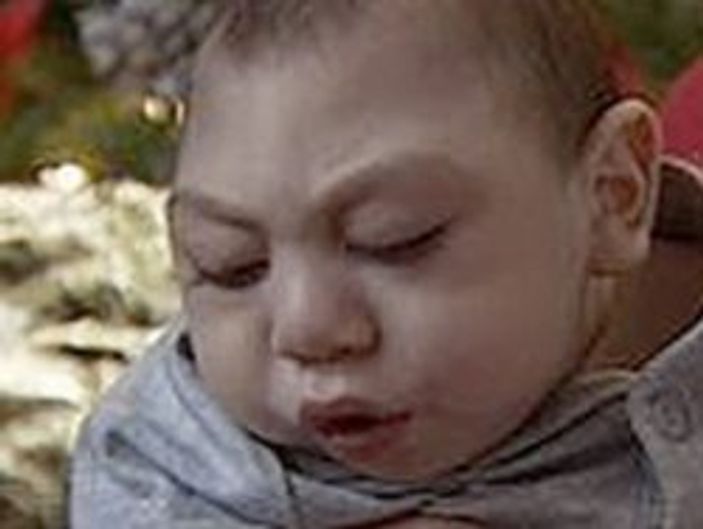 Beyni olmadan 3 yıl yaşadı