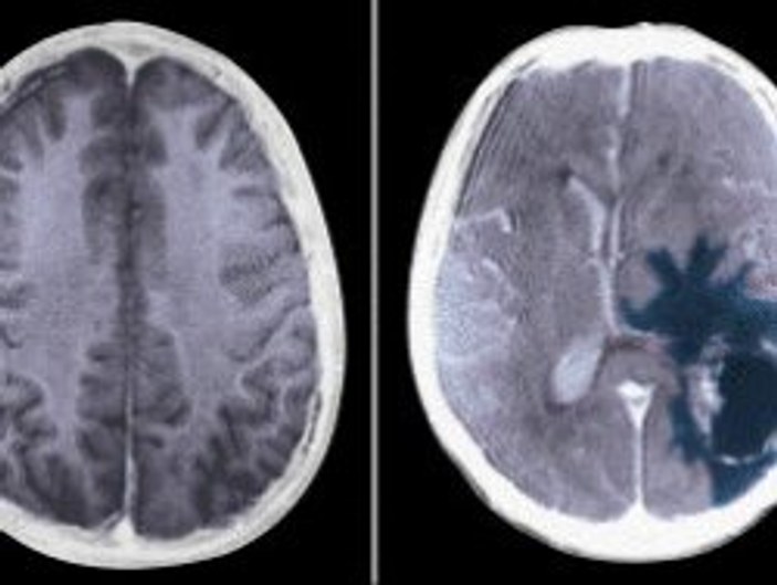 Beyin tümörlerinde yaşam süresi uzatıldı
