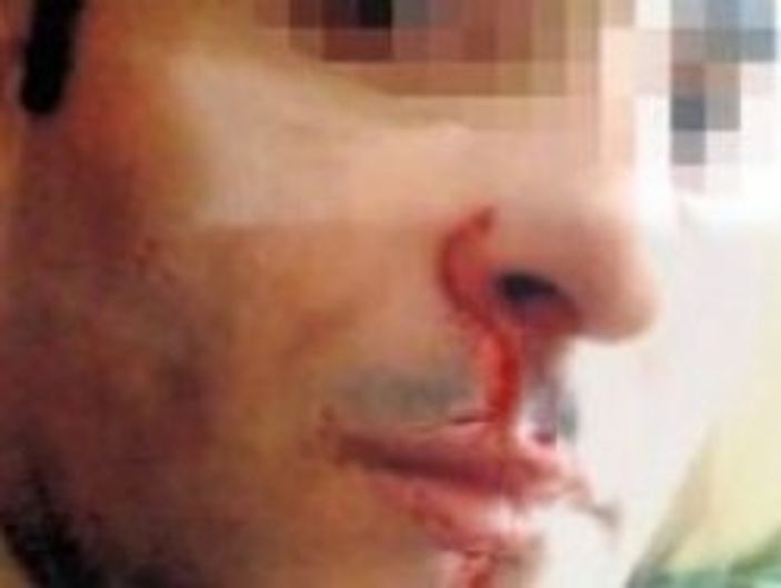 Bu kez erkeğe şiddet: Karım içip içip beni dövüyor