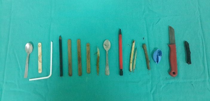 Çocuğun midesinden 15 parça yabancı cisim çıktı