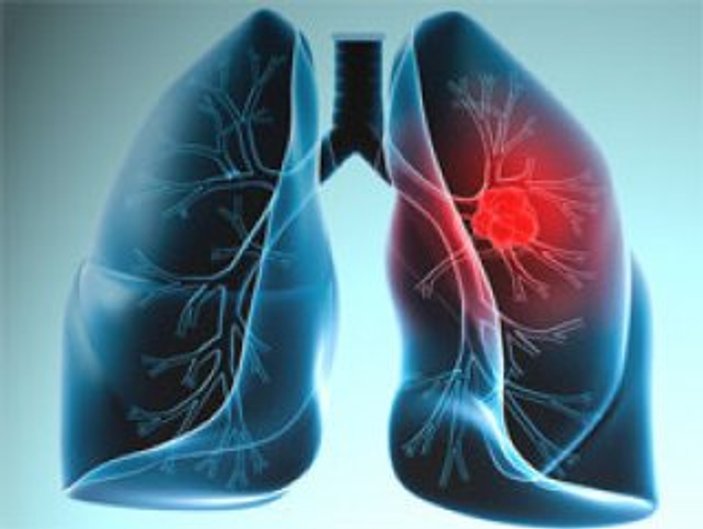 Nefesten akciğer kanseri teşhisi yakın