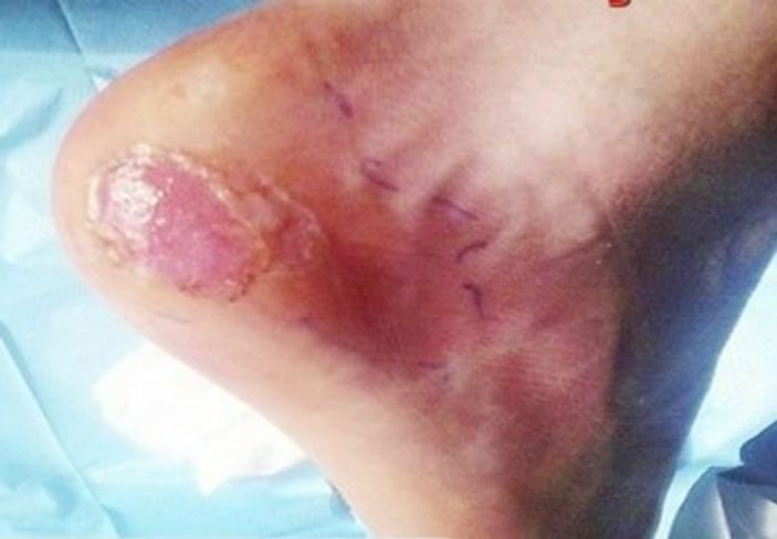 Ayağı su toplayan çocuk ölümden döndü