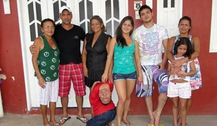 Brezilya'da boynu ters doğan adam 37 yaşında