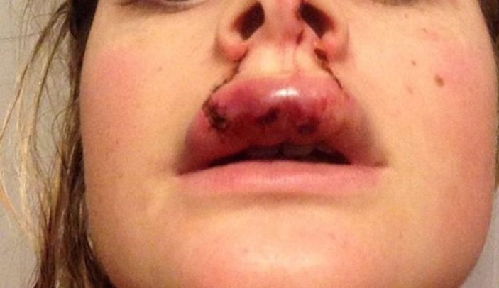 Kıskanç genç sevgilisinin üst dudağını kopardı