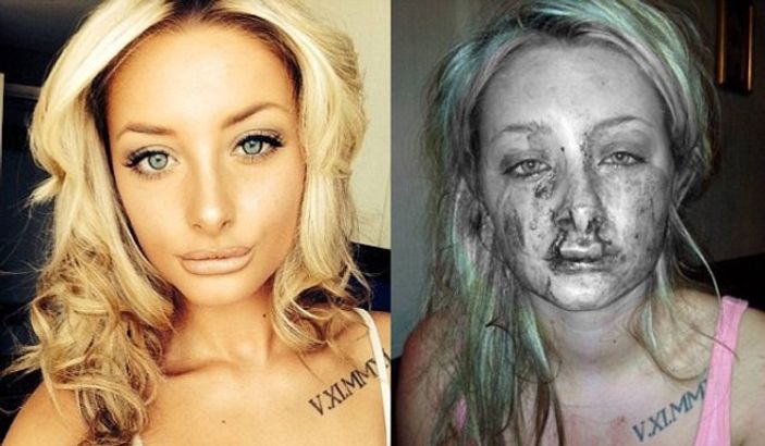 Kıskanç genç sevgilisinin üst dudağını kopardı