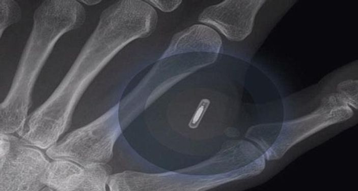 Avustralya'da bir kişi iPhone için eline çip taktırdı