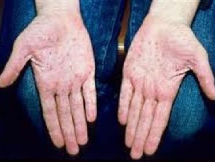 Sedef hastalığı için umut ışığı