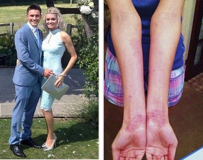 Egzemalarıyla dalga geçilen kız güzellik kraliçesi oldu