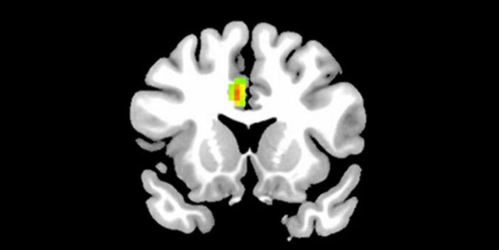 Aşık insanların beyin MR'ı çekildi