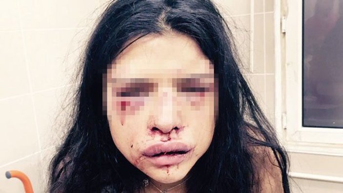 Onur Özbizerdik'in dövdüğü kız arkadaşı dehşeti anlattı