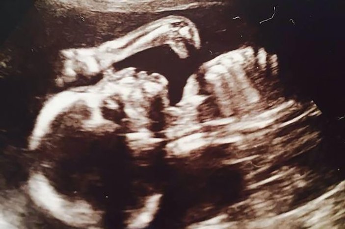 Hamile kadının ultrasonunda dinozor görüldü